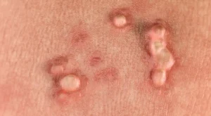 درمان زگیل تناسلی