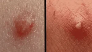 تفاوت زگیل و تبخال و جوش ناحیه تناسلی