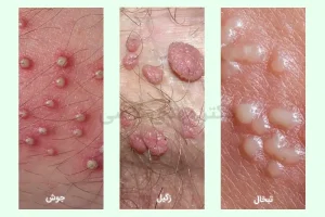 تفاوت زگیل و تبخال و جوش ناحیه تناسلی
