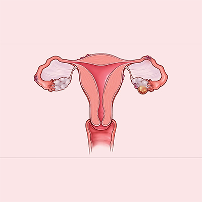 آندومتریوز