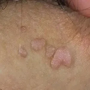 تفاوت زگیل و تبخال و جوش ناحیه تناسلی