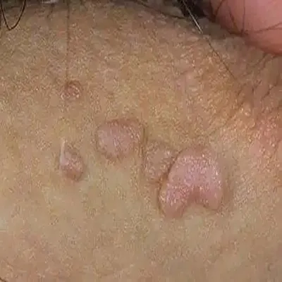 تفاوت زگیل و تبخال و جوش ناحیه تناسلی