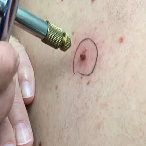 HPV
